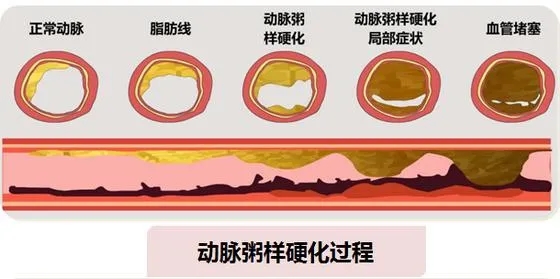 肥胖的人血脂就一定高吗如果你这样认为就错了